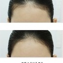 살아있는 헤어라인