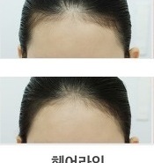 살아있는 헤어라인